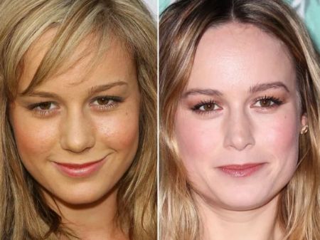 Brie Larson in 2007 before surgery in left and after surgery in 2017.